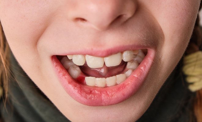 The danger of dreaming that your lower teeth fall out